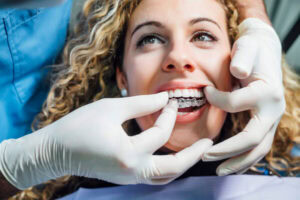 Dentist fitting a clear aligner on a female patient’s teeth