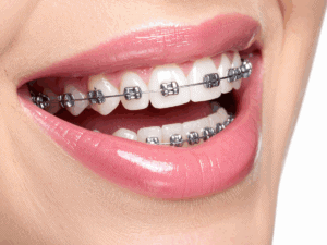 first week with braces