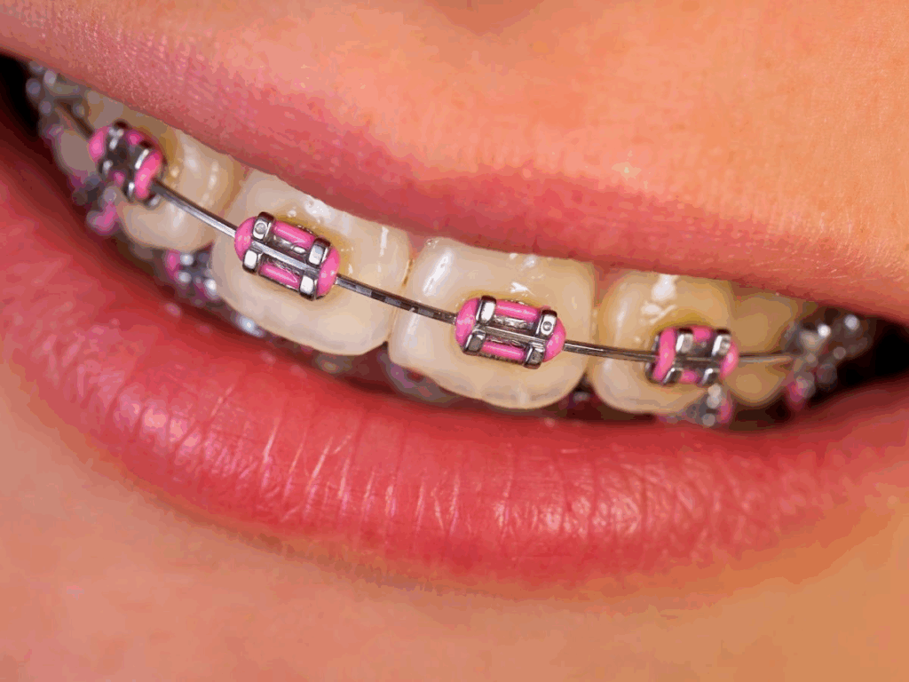 first week with braces