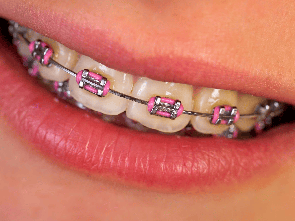 first week with braces