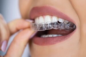 Person placing clear Invisalign aligners