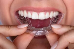 Invisalign aligners being inserted