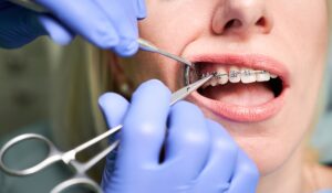 Close-up of orthodontic treatment being performed on a patient with metal braces