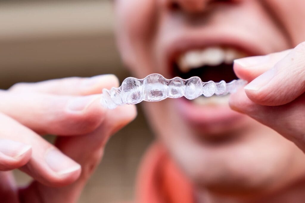 Close-up of a man's hands holding an invisible plastic brace tray up to his open mouth